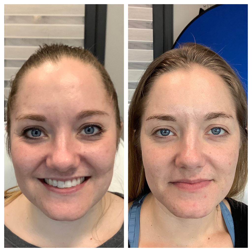 Microneedling Before and After Photo by Kim Engelhardt, MSN, APRN, ANP-BC in Brentwood, Tennessee