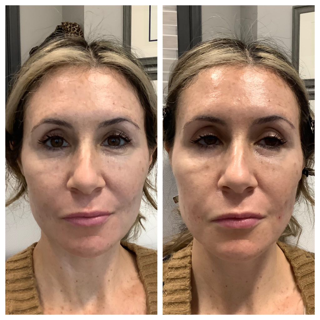 Filler Before and After Photo by Kim Engelhardt, MSN, APRN, ANP-BC in Brentwood, Tennessee