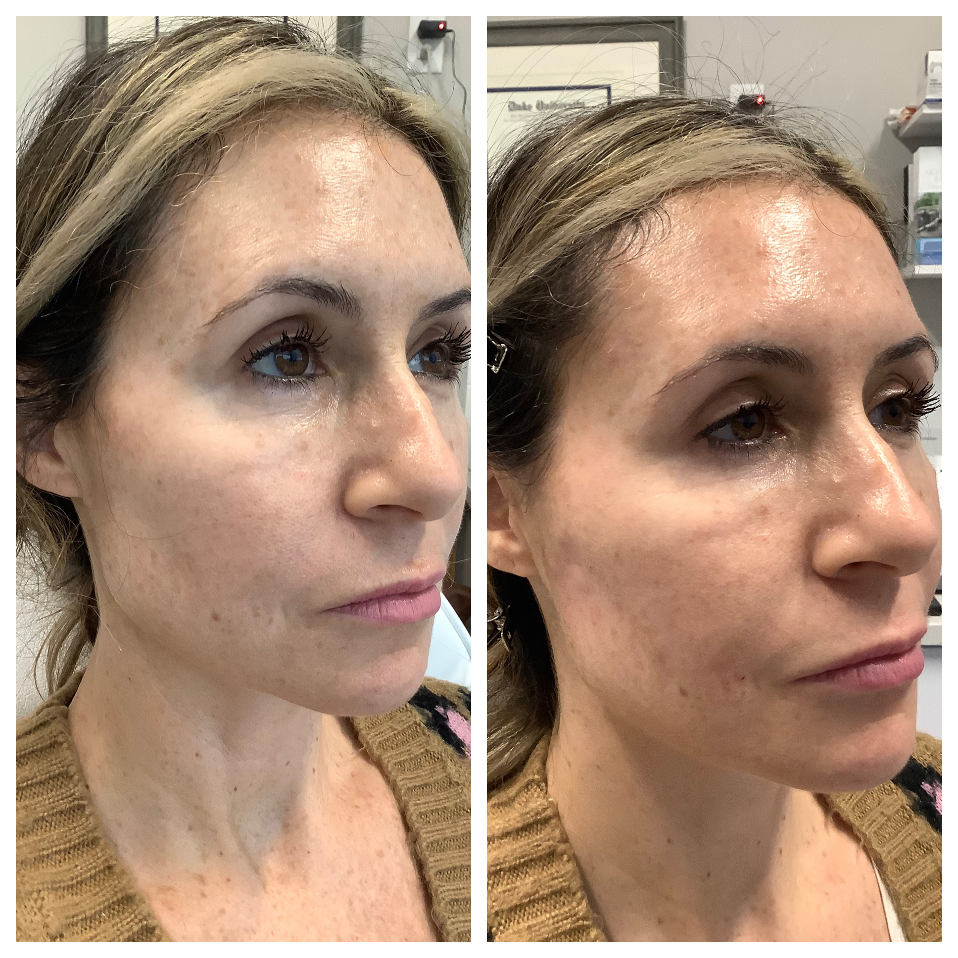 Filler Before and After Photo by Kim Engelhardt, MSN, APRN, ANP-BC in Brentwood, Tennessee