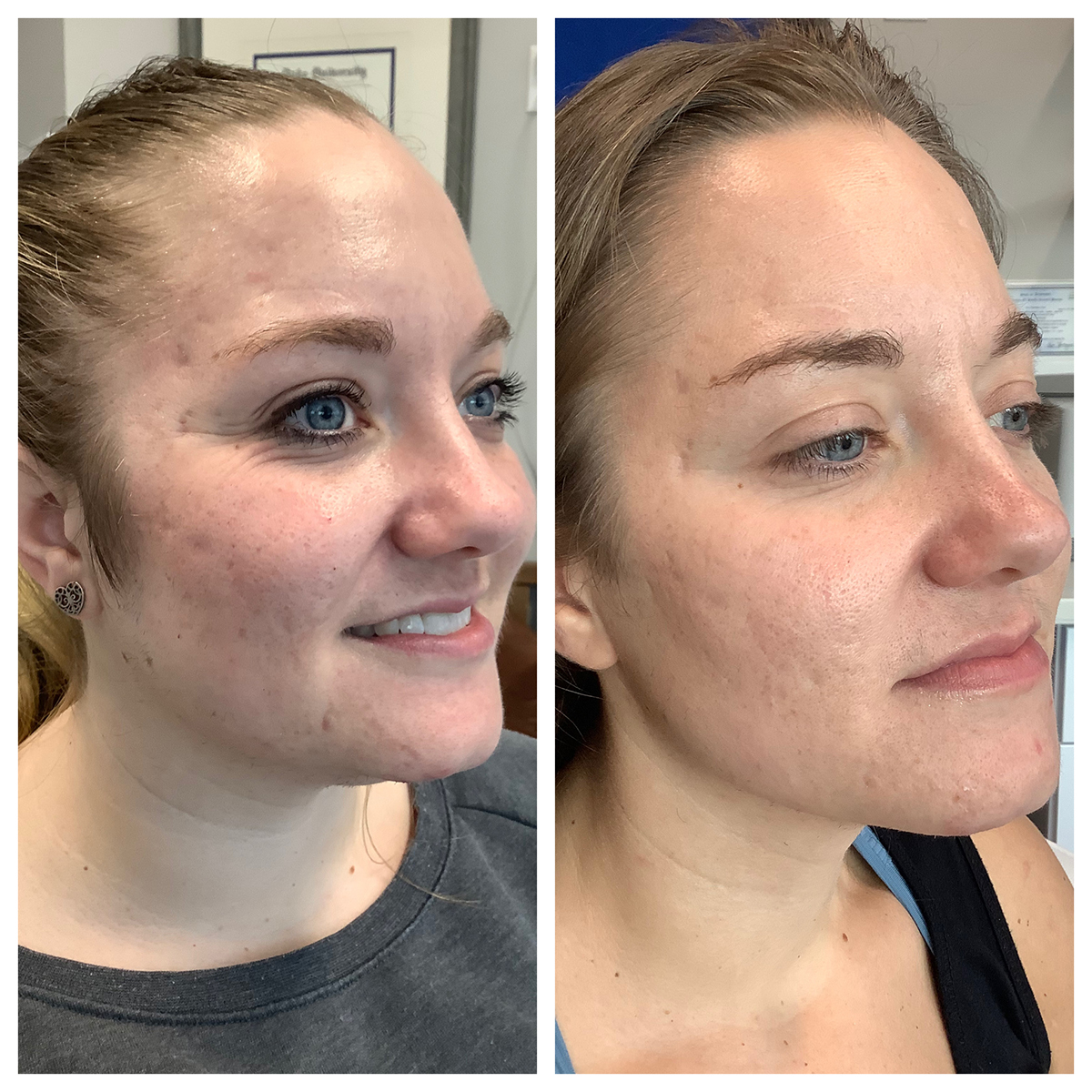 Microneedling Before and After Photo by Kim Engelhardt, MSN, APRN, ANP-BC in Brentwood, Tennessee