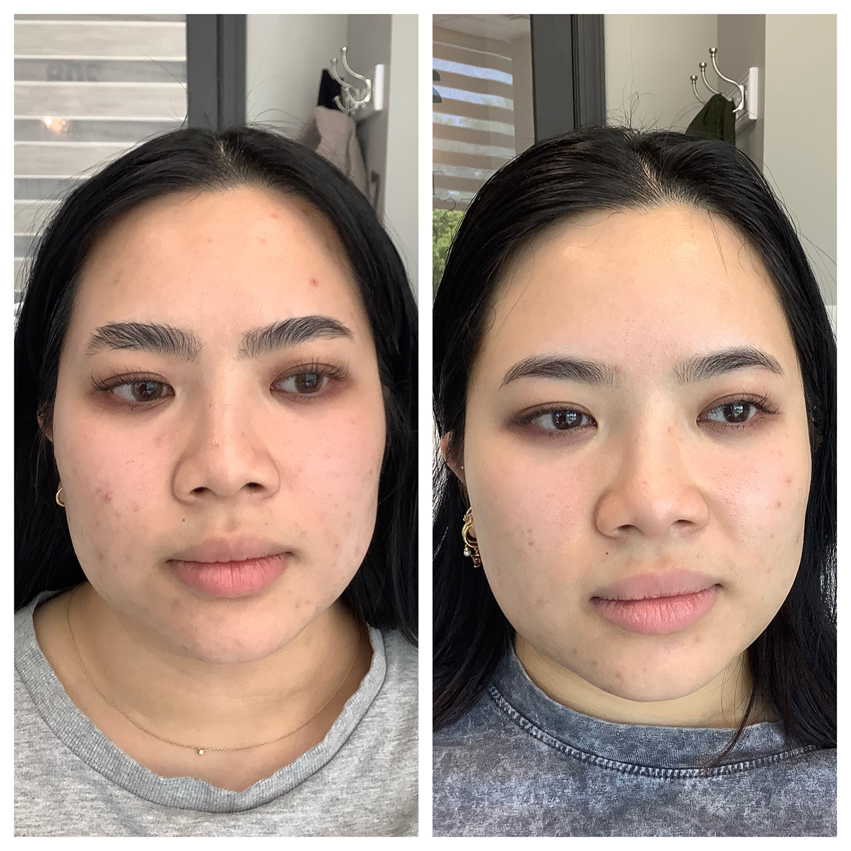 ZO 3 Step Before and After Photo by Kim Engelhardt, MSN, APRN, ANP-BC in Brentwood, Tennessee