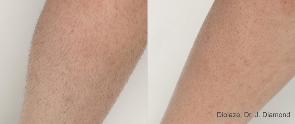 DiolazeXL Before and After Photo courtesy of Dr. J. Diamond in Brentwood, Tennessee