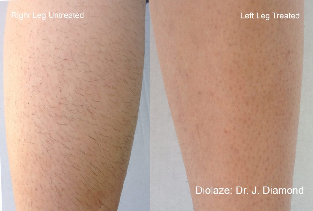 DiolazeXL Before and After Photo courtesy of Dr. J. Diamond in Brentwood, Tennessee
