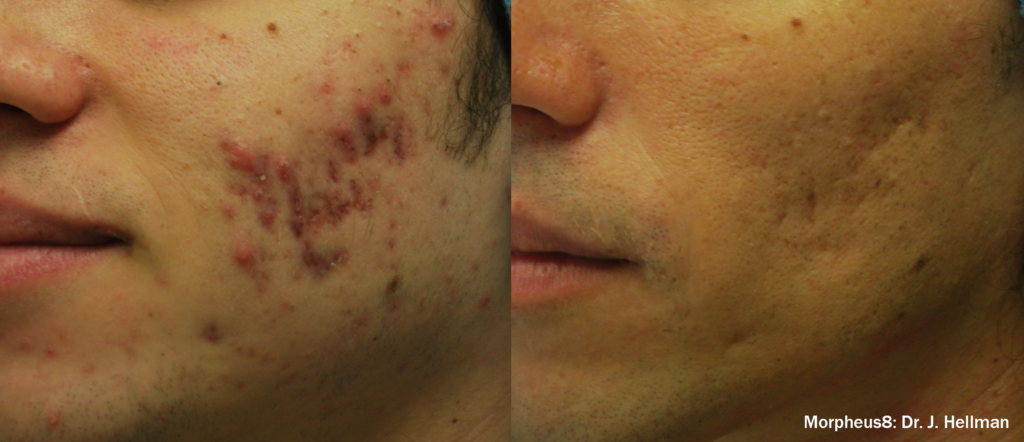 Morpheus8 Before and After Photo courtesy of Dr. J. Hellman in Brentwood, Tennessee