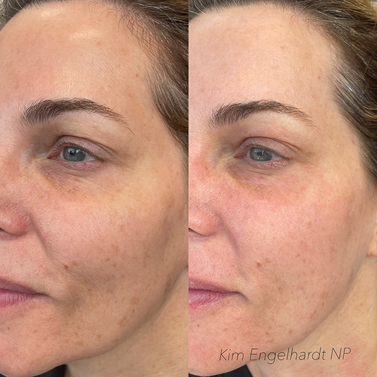 Diamond Glow Before and After Photo by Kim Engelhardt, MSN, APRN, ANP-BC in Brentwood, Tennessee