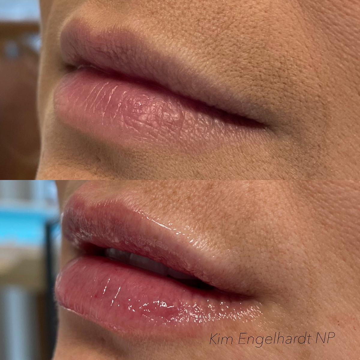 Lip Filler Before and After Photo by Kim Engelhardt, MSN, APRN, ANP-BC in Brentwood, Tennessee