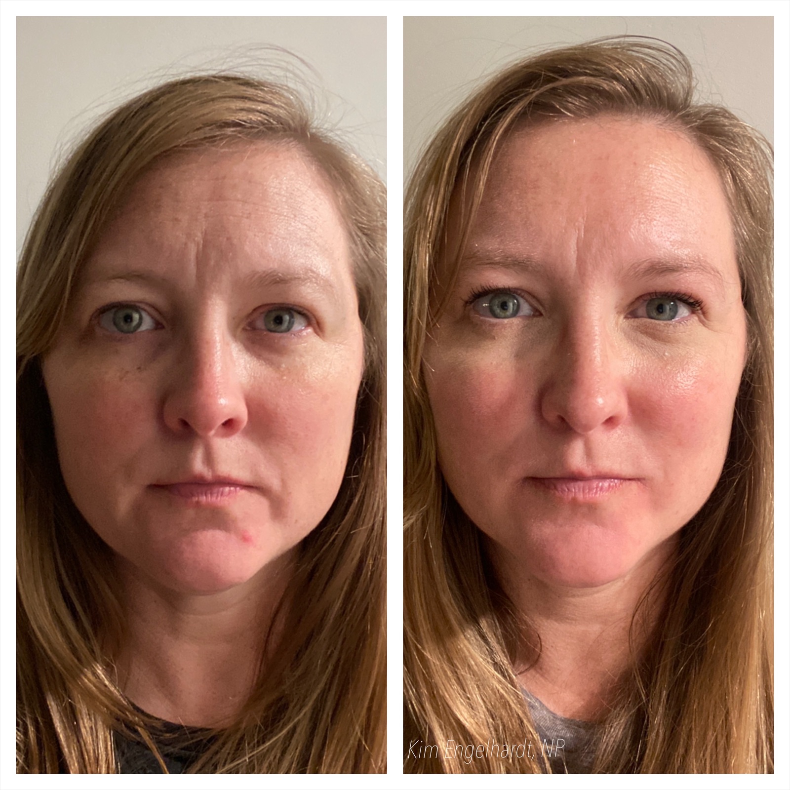 Chemical Peel Before and After Results